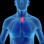 Tumore esofago, sintomi e fattori di rischio