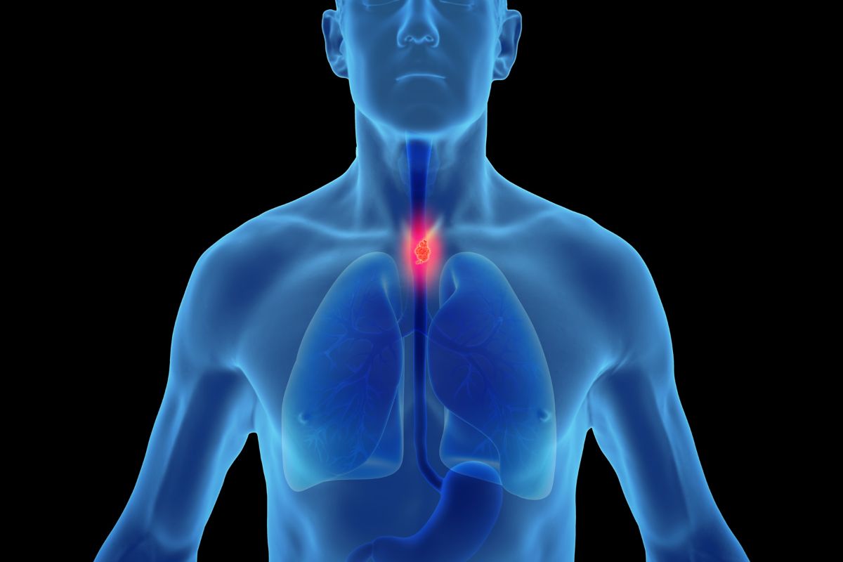 Tumore esofago, sintomi e fattori di rischio